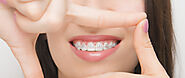 An Essential Guide About Orthodontic Appliances And Their Uses