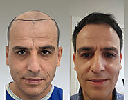 Hair Transplant for Women - Sercan Aslan Hair Clinic