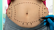 Tummy Tuck ( Abdomino Plasty) Treatment in Vadodara