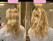 Tru Bloom Hair Vitamins For Cushing Disease Hair Loss