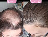 Autoimmune Diseases Hair Loss Treatment At ST. TROPICA