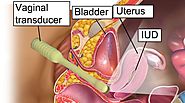 Uterine Fibroids and Their Impact on Women Fertility
