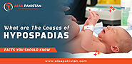 What are the causes of hypospadias |Facts you should know?