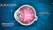 Glaucoma — Symptoms, Causes, Treatment & More