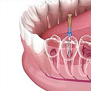 Professional Root Canal Therapy at Port St Lucie