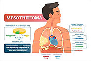 Mesothelioma Lawyers, Compensation, Causes, Types, Symptoms and Treatment - bioDtells