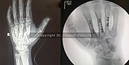 Best Treatment for Hand Fracture Doctor in Delhi NCR, Best Hand Fracture Hospital in Delhi NCR, hand fracture surgery...