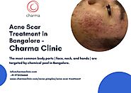 Acne Scar Treatment in Bangalore - Charma Clinic