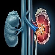 Kidney Stone: All Symptoms and Diagnosis