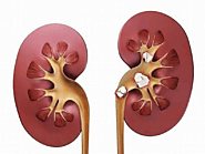 How is the Kidney Stone Treated?