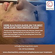 Here is a Quick Guide On the Best Acne Scar Treatments in 2023