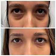 Non-Surgical Eyelid Lift – Tear Trough Filler (Non-Surgical Blepharoplasty)