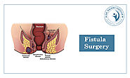 Fistula Doctor in Chandigarh