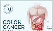 Colon Cancer Surgery: What to Expect and How to Choose a Skilled Surgeon in Chandigarh