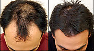 Hair Transplant in Qatar