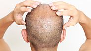 Ways to Fight Men's Hair Loss