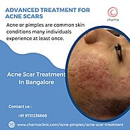 Advanced treatment for Acne Scars – Dr. Rajdeep Mysore : Skin Specialist in Bangalore