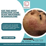 Get the Most Effective Acne Scar Treatment in Bangalore