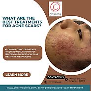 Get Spotless Skin with Acne Scar Treatment in Bangalore - Charma Clinic