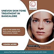 Uneven Skin Tone Treatment in Bangalore - Charma Clinic