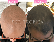 ST. TROPICA Hair Vitamins For Lupus And Hair Loss Treatment