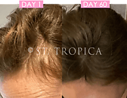 Best Hair Growth Vitamins For Thyroid Hair Loss At ST.TROPICA