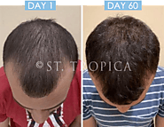 Best Hair Mask Treatment for Men's Hair Loss At ST.TROPICA