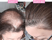 Autoimmune Diseases Hair Loss Treatment At ST. TROPICA