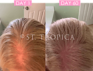 Hair Growth Serum For Covid 19 Hair Loss At ST.TROPICA In US