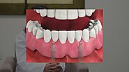 Implant-Supported Dentures | My Dentist for Life