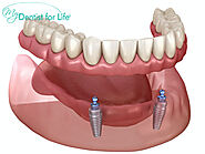 Implant-Supported Dentures Treatment in Plantation