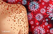Monkeypox Virus (2022): Treatment, Symptoms, Prevention, Pictures, India- Virohan