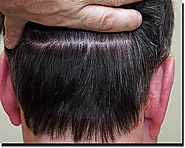 How Fue Hair Transplant Process Works?