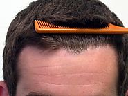 Post Operative Care for FUE Hair Transplant Surgery