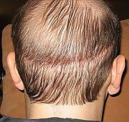 Cause of Hair Shedding After a Hair Transplant