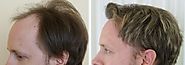 Are You A Good Candidate For Hair Transplant Surgery?