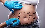 Cosmetic Surgery Tummy Tuck Surgery Treatment in Coimbatore