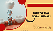 What Are the Top 5 Signs That You Need Dental Implants?