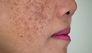 What is best skin treatment for melasma | ClearSkin, Pune