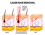 Best Laser Hair Removal in Dubai