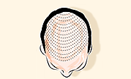 Genetic Links to Alopecia Areata