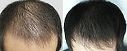 How To Treat Androgenic Alopecia In Men