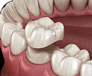 Crowns and Bridges Ultimo | Dental Bridges Ultimo | Lumina Dental