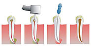 Root Canal Treatment in Vikas Puri