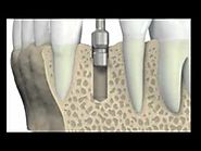 Dental Implant in Uttam Nagar - Punhani Tooth Care