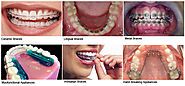Orthodontic Treatment in Delhi: Punhani Tooth Care