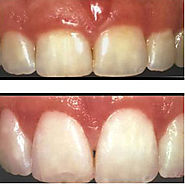 Dental Implants Janakpuri - Punhani Tooth Care