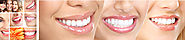 Fillings (Restorations) - Punhani Tooth Care