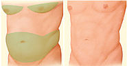 Liposuction Delhi India, Fat Reduction, Body Reshaping