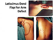 Upper Limb & Hand Defects Treatment